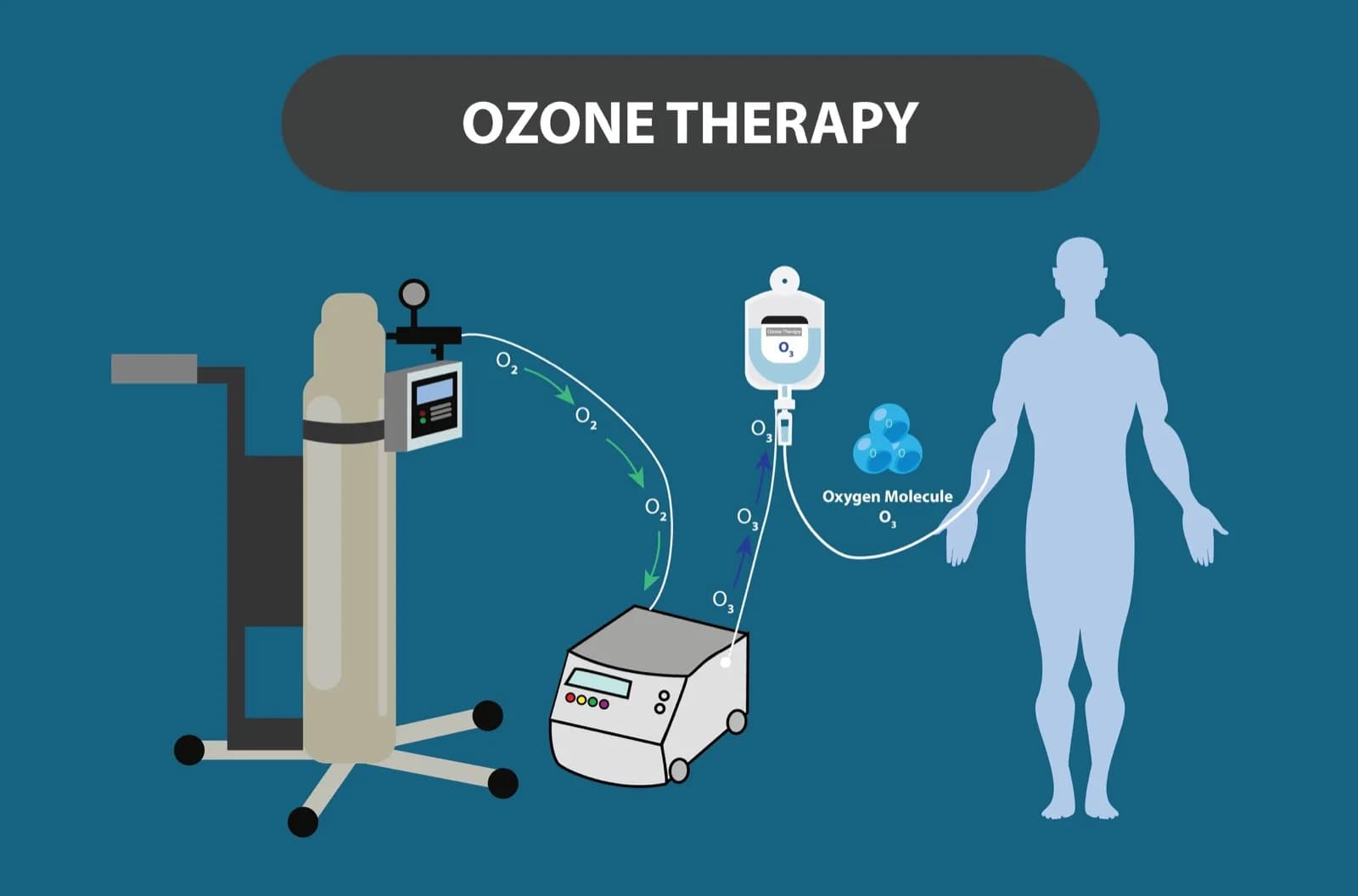 Ozone Therapy